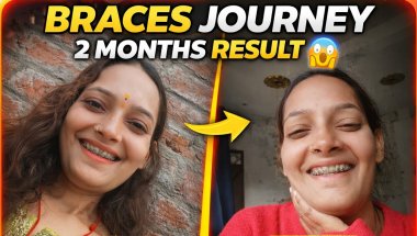 2 Months Braces Journey Experience | Before After Teeth Transformation | Honest Braces Update#braces