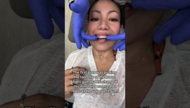 BRACES JOURNEY Adding 2 TADS/screw, lower Braces adjustment & adding more Bite blocker/ turbos