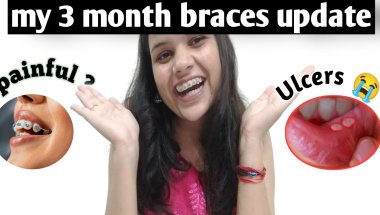 My Braces Journey 3 month update  pain, struggles & changes ?🤔