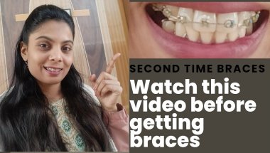 My braces experience| Braces Lagwane Wale Aur Jinke Braces Chal Rahe Hain–Ye Video Zaroor Dekho!
