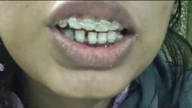 My 6th appointment with dentist☺💕!#braces #bracestransformation #dentalbraces #videos #dentalbraces