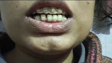 Braces experience#braces ;!!🥰#dentist #dentalbraces #smiledesigndental #dentalcare #youtubeindia