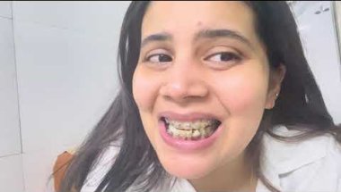 Braces hatne ke baad teeth pe bleach krwana sai rahega ?#viral ##braces #trending #teeth
