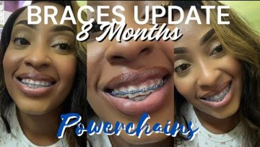 BRACES UPDATE: 8 MONTHS | POWER CHAINS, CLOSING GAPS