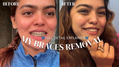 Finally😍🦷❤️My Braces out after 9 months 🦷#braces #vlog #viral #trending #trendingvideo #explore