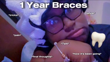 1 YEAR W/ BRACES UPDATE