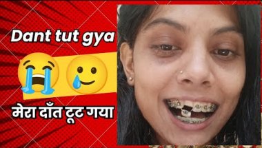 Kya braces mein daant toot🤒 sakta hai? 😬 Sach dekho 🦷
