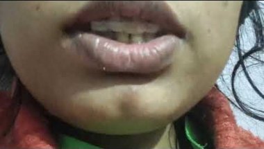 My braces jounery👍!! My experience🥰👌#braces #smiledesigndental #bracestransformation #youtubeindia 🌸