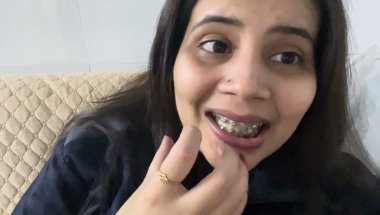 My 10 Months 10 day braces journey #trending #teeth #braces #viral #dentalprosthesis