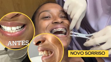 Removi meu aparelho ortodôntico e vou fazer clareamento caseiro