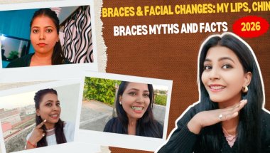 Braces & Facial Changes: My Lips, Chin - ( Myth vs Reality ll braces myths and facts 2026