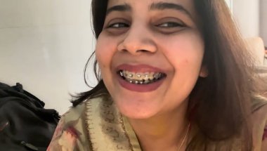 10 Months 13 day Braces journey #viral #dentist #trending #teeth #dentalcare #teeth #dentalprosthesi