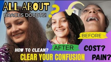 All about braces doubts 🦷🤔|2.5 months braces journey|My braces journey