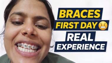 Braces First Day Experience 😬 | Dard, Discomfort & Reality | Hindi