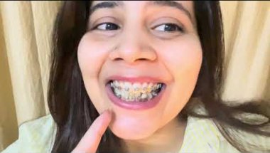 10 Months 16 days Braces journey #viral #trending #dentalcare #teeth #dentist #braces #youtube