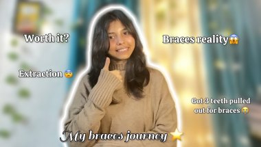 “I Got 3 Teeth Pulled Out for Braces 😱| Painful or not? 😭| My Honest Braces Journey”🦷