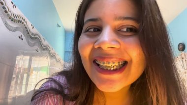 10 Months 17 day Braces journey #viral #trending #dentalcare #teeth #braces #youtuber#viralvideo