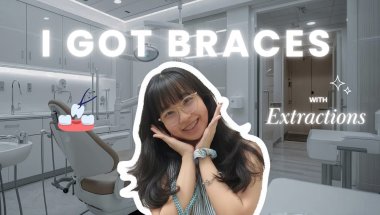 I Got Braces (With Extractions) | Before, During & After