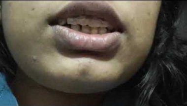 Lower teeth braces experience🥰 🙆‍♀️?? '#braces #love #smiledesigndental #bracestransformation🙏🙏
