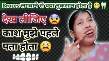 Braces लगवाने से क्या नुकसान होता है 😬😨🦷||painful | देख लीजिए 😨😨....
