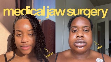 jaw surgery ruined my life..