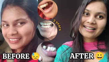 BEFORE & AFTER || 😥🦷LIFE CHANGING BRACES TRANSFORMATION || 2 - साल में कितने Changes हुए?