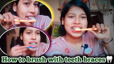 How to clean teeth with braces🦷😬 || how to brush with braces || braces clean kaise kare....