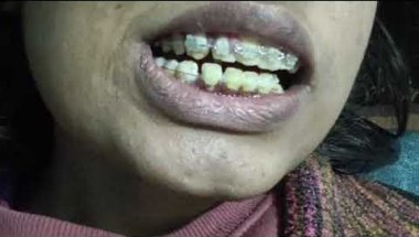 Lower teeth braces?!! 🥰❤😌#love #braces #smiledesigndental #dentalbraces #bracestransformation #smile