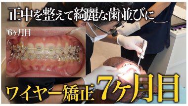 【治療7ヶ月】正中を整えて綺麗な歯並びに！ワイヤー矯正の調整風景に密着【名古屋ルミナス歯科・矯正歯科】