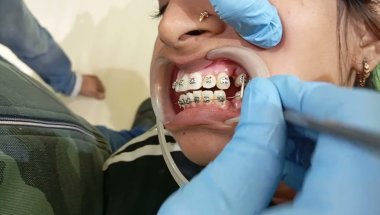 Fixing Braces Teeth | Best Dentist in Patna | Dr. Abhishek Kumar
