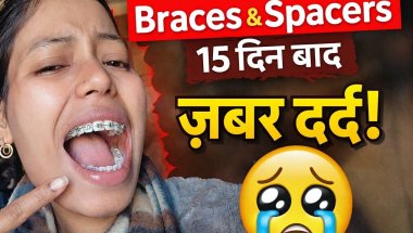 15 day of braces..aur spacers ka dard 😫 #braces #vlog #bracescare #pain