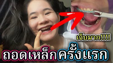 ถอดเหล็กจัดฟันแล้วนะ