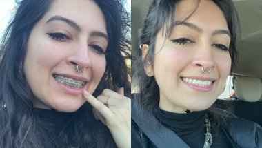 your gen z rdh gets their braces off