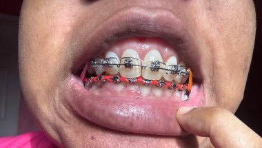 DEEP TOUR OF MOUTH BEFORE DENTAL CLEANING
