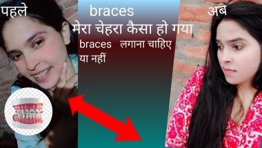 My braces life#painful life