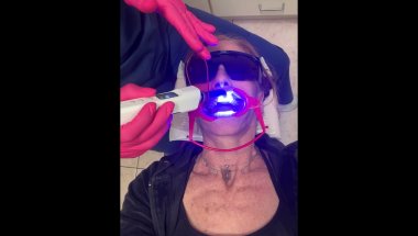 #adultbraces journey. Step 3. @orthomike in #bocaratonfl.