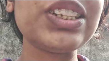 My braces exercise😇🥰☺?? #braces #love #smiledesigndental #tranformation #smileorthodontics #youtube