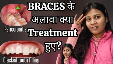 Danto ka bura haal! 😭 Pericoronitis + Cracked Tooth + Braces🦷🫠