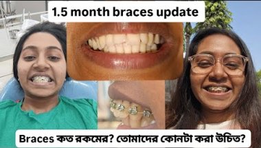 1.5 month Braces update 🥲 / Braces কি? তোমাদেরও কি করা উচিত?  #braces #bracesjourney #bracesupdate