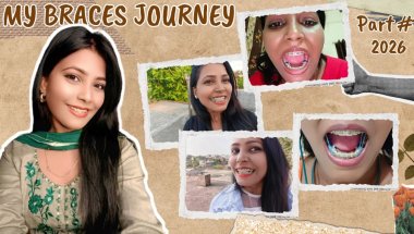 how to maintain teeth after braces ll how long do i need to wear a retainer after braces#braces