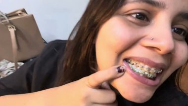 10 Months 30 days braces update #viral #dentalbraces #teeth #dentist #braces #viralvideo #youtube