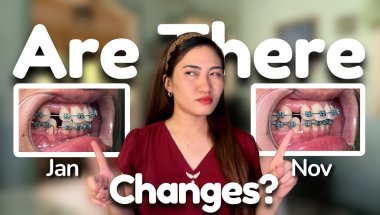 One Year of Braces Updates | Here's What Happened in 2025!