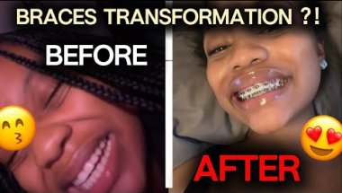 FINALLY GETTING BRACES ON!! , awkward RAW first video 🥴