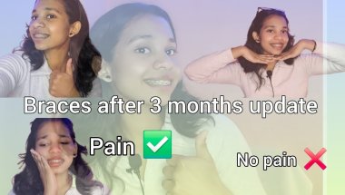 After 3 months braces update #bracesjourney #braces#bracestransformation