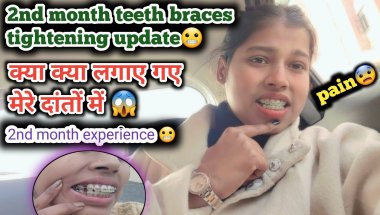 2nd month teeth braces tightening update😬🦷||painful #braces #viral #vlog #subscribe .....