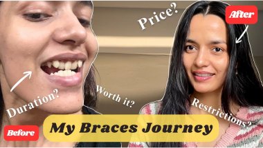 Everything You Need To Know About BRACES 🦷 | Cost? | Duration | Restrictions? ❓