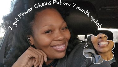 I Got Power Chains Put On My Braces | Power Chains for Braces #braces #🪥✨