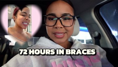 My First 72 Hours With Braces (What It Actually Felt Like)
