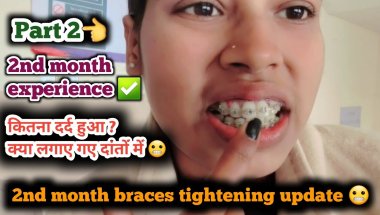 My 2nd month braces tightening update 🦷😬 || Part 2 #viral #vlog #dentist #dental #subscribe ....