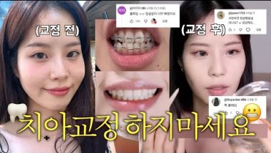 치아교정 전 필수시청😬 30대 교정 브이로그 시작부터 끝!(총 비용, 교정기간, QnA까지/부작용 제대로 온 사람의 솔직후기)